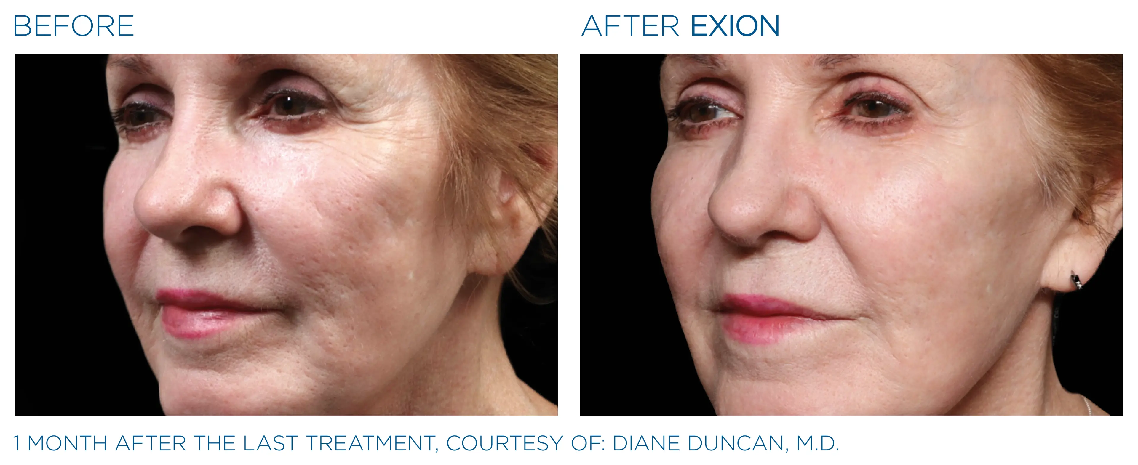 EXION before and after — female cheek, smoother skin texture