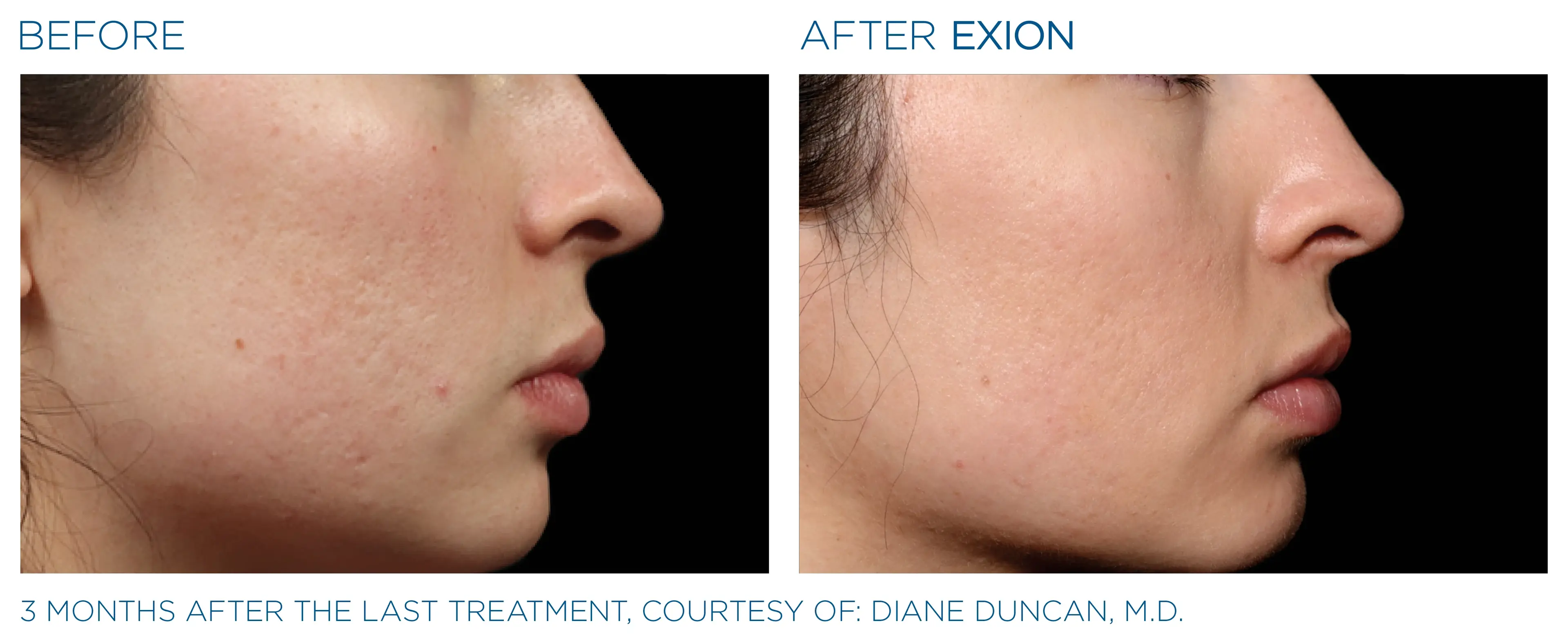 EXION before and after — female cheek, refined texture and contour