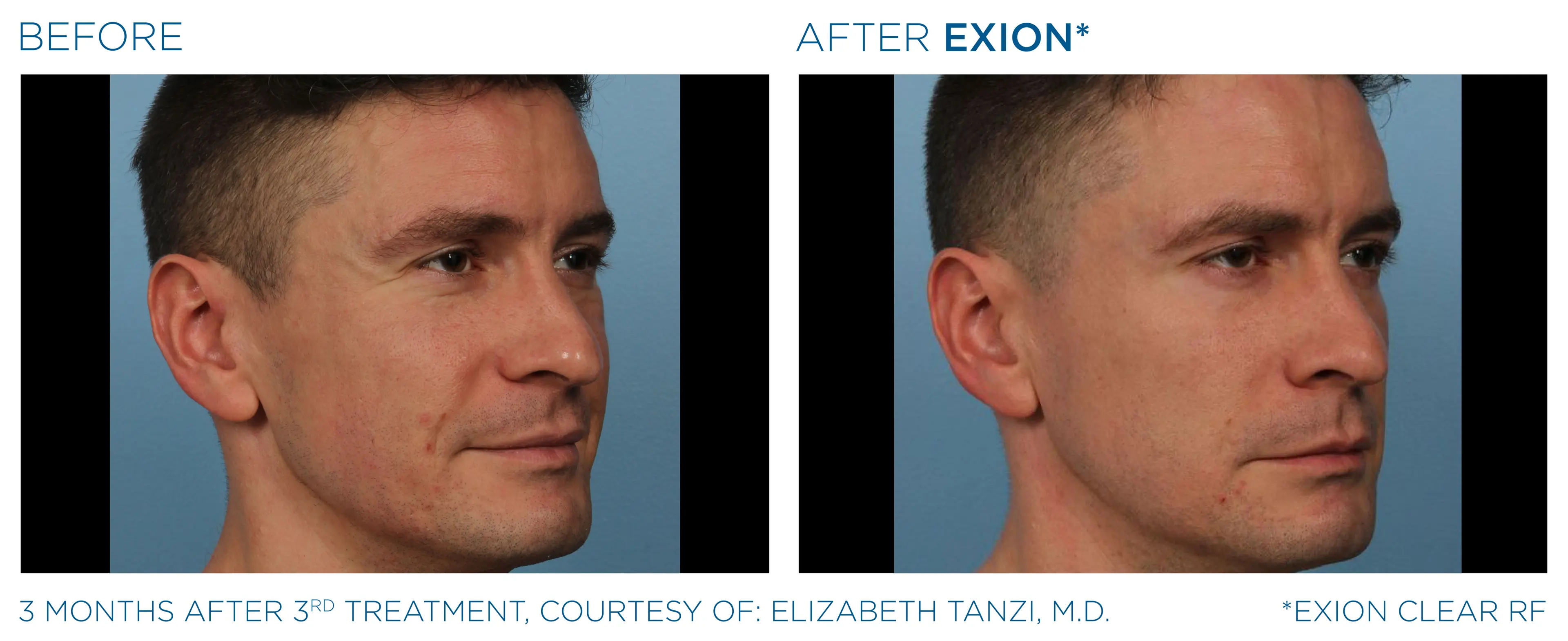 EXION Clear RF before and after — male face