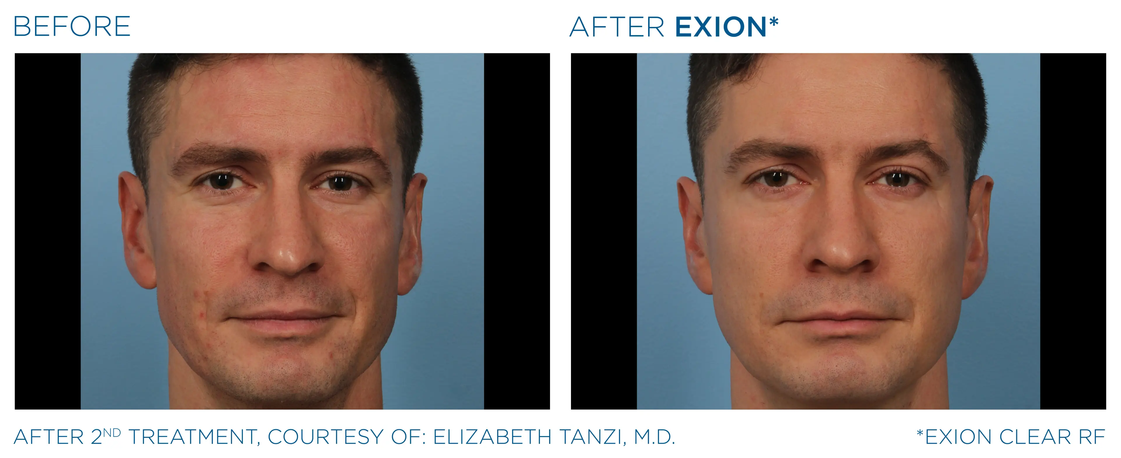 EXION Clear RF before and after — male face, refined results