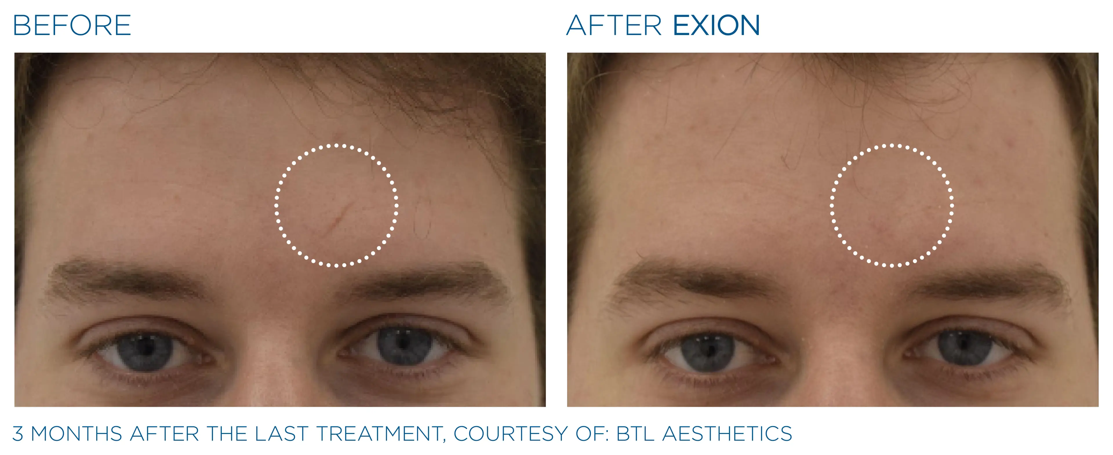 EXION before and after — male forehead, clearer smoother skin